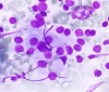 Hashimotos_thyroiditis,_oncocytic_cells_with_lymphs,_DQ_hp__SM.jpg