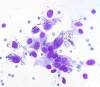 Filename=Lymphocytic_thyroiditis,_reparative_follicular_cells_with_hemosiderin_SM,_DQ_hp.jpg
Filesize=869KiB
Dimensions=1050x914
Date added=May 25, 2015 Lymphocytic_thyroiditis,_reparative_follicular_cells_with_hemosiderin_SM,_DQ_hp.jpg