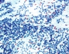 Filename=Lymphocytic_thyroiditis1,_Pap,_lp_SM_.jpg
Filesize=1341KiB
Dimensions=1050x839
Date added=May 25, 2015 Lymphocytic_thyroiditis1,_Pap,_lp_SM_.jpg