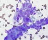 Filename=MNG,_oncocytic_change,_DQ_hp.jpg
Filesize=1125KiB
Dimensions=1632x1347
Date added=May 16, 2015 MNG,_oncocytic_change,_DQ_hp.jpg