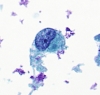 Filename=Met_PD_breast_CA_to_thyroid,_huge_cell,_PAP.jpg
Filesize=257KiB
Dimensions=552x525
Date added=May 16, 2015 Met_PD_breast_CA_to_thyroid,_huge_cell,_PAP.jpg