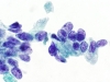 Met_esophageal_CA_c.jpg