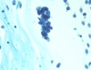 MetastaticMerkelCell.jpg