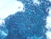 Metastatic_Colon_CA.jpg