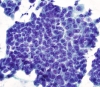 Filename=Papillary_CA,_disordered_nuclei_in_sheet_of_tumor,_PAP_sm.jpg
Filesize=1097KiB
Dimensions=1032x902
Date added=May 17, 2015 Papillary_CA,_disordered_nuclei_in_sheet_of_tumor,_PAP_sm.jpg