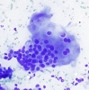 Papillary_CA,_giant_cell,_DQ_lp~0.jpg