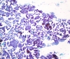 Filename=Papillary_CA,_high_cellularity_3,_PAP_lp~0.jpg
Filesize=1490KiB
Dimensions=1150x966
Date added=May 17, 2015 Papillary_CA,_high_cellularity_3,_PAP_lp~0.jpg