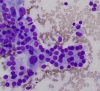 Filename=chronic_Lymph_ocytic_thyroiditis-_microfollicle_formation_in_oncocytes-_DQ-medium-crothers.jpg
Filesize=131KiB
Dimensions=657x600
Date added=Nov 05, 2010 chronic_Lymph_ocytic_thyroiditis-_microfollicle_formation_in_oncocytes-_DQ-medium-crothers.jpg