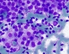 Filename=chronic_lymphocytic_thyroiditis-_oncocytes_surrounded_by_mature_lymphocytes-dq-high-crothers-3_.jpg
Filesize=184KiB
Dimensions=756x600
Date added=Nov 05, 2010 chronic_lymphocytic_thyroiditis-_oncocytes_surrounded_by_mature_lymphocytes-dq-high-crothers-3_.jpg