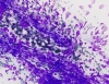 chronic_lymphocytic_thyroiditis-typical_nuclear_streaking_of_lymphocytes-dq-low-crothers.jpg