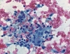 Filename=subacute_granulomatous_thyroiditis-An_admixture_of_epithelioid_histiocytes,_multinucleated_giant_cells_and_lymphocytes-pap-high-ali.JPG
Filesize=220KiB
Dimensions=774x600
Date added=Sep 04, 2009 subacute_granulomatous_thyroiditis-An_admixture_of_epithelioid_histiocytes,_multinucleated_giant_cells_and_lymphocytes-pap-high-ali.JPG