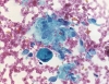 Filename=subacute_granulomatous_thyroiditis-epithelioid_histiocytes_and_scant_background_colloid-high-pap-ali.JPG
Filesize=213KiB
Dimensions=774x600
Date added=Sep 04, 2009 subacute_granulomatous_thyroiditis-epithelioid_histiocytes_and_scant_background_colloid-high-pap-ali.JPG